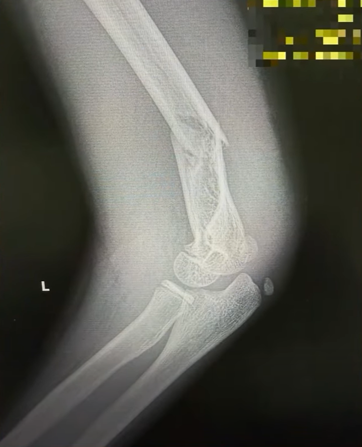 Lekarze alarmują: rośnie liczba ciężkich urazów po hulajnogach elektrycznych